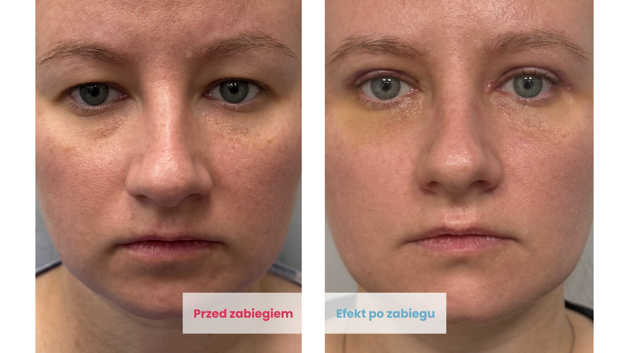 Efekty przed i po zabiegu blefaroplastyki w DCG Centrum Medyczne