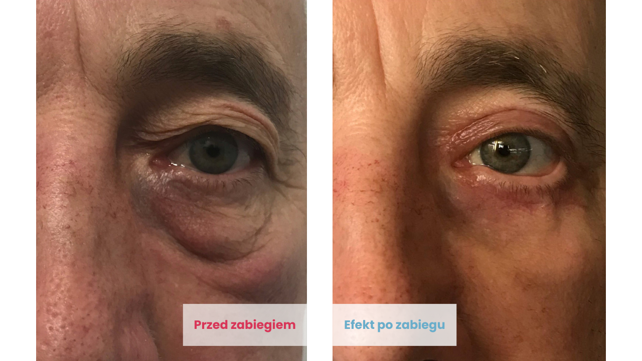 Efekty przed i po zabiegu blefaroplastyki w DCG Centrum Medyczne