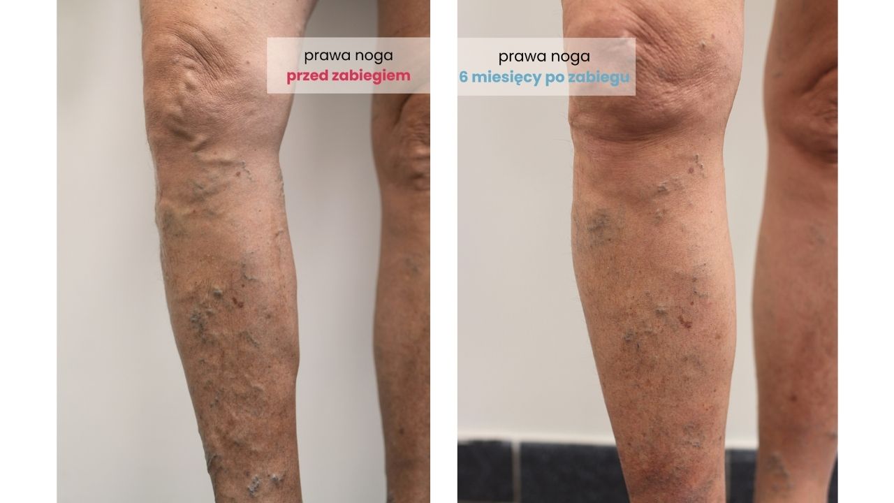 Noga przed i po zabiegu skleroterapii w DCG Wrocław