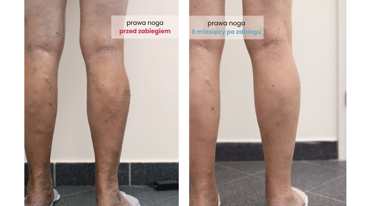 Zdjęcia przed i po zabiegu skleroterapii DCG Centrum Medyczne