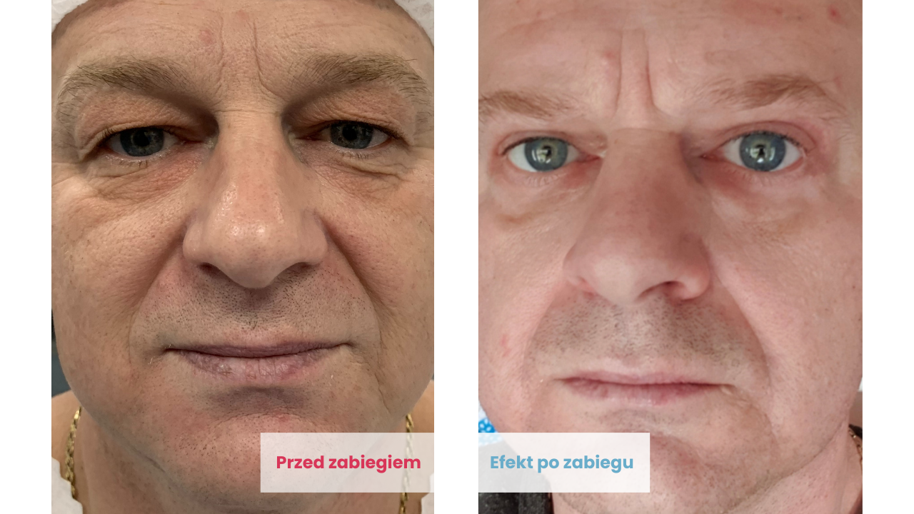 Efekty przed i po zabiegu blefaroplastyki w DCG Centrum Medyczne