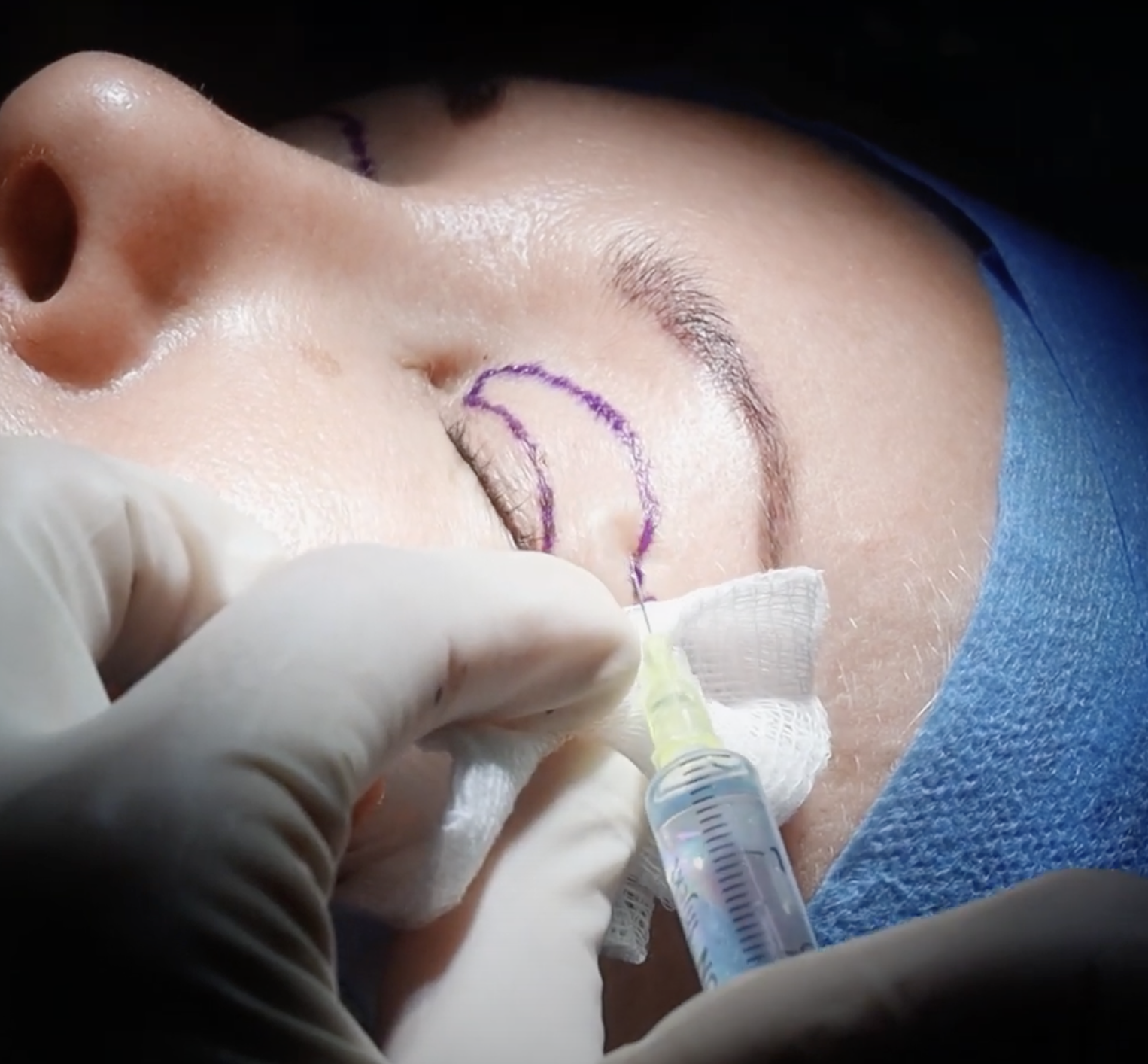 Zabieg plastyki powiek w DCG Centrum Medyczne