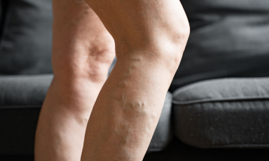 Żylaki nóg występujące na łydce