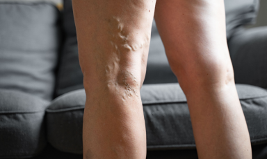 Żylaki nóg występujące nad i pod kolanem