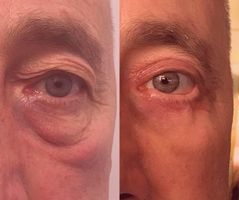 Zdjęcie przedstawia Pacjenta przed i po zabiegu plastyki powiek dolnych